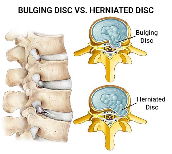 Disc Herniation Vs Disc Bulge Whats The Difference Health Hub Chiro Chiropractor Lismore